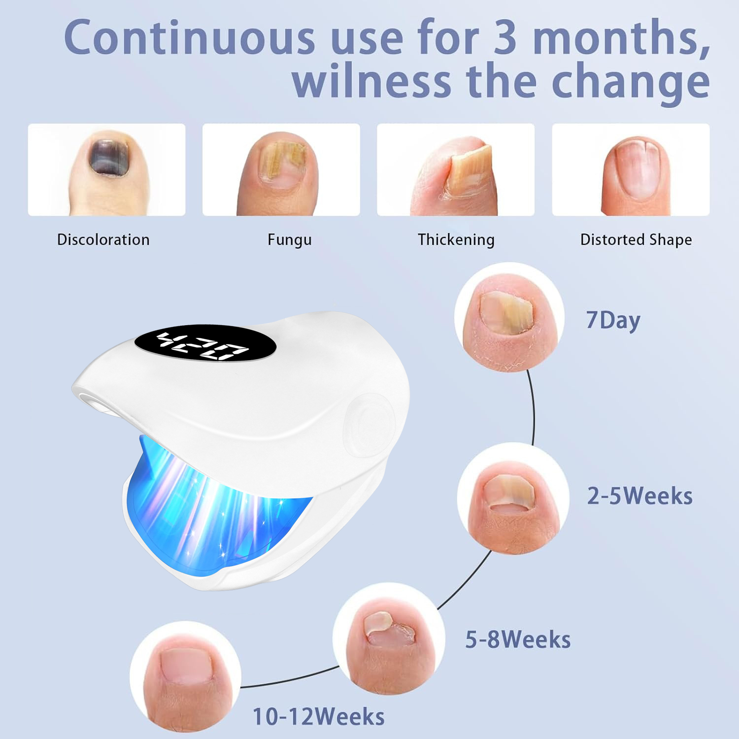 손발톱 무좀 레이저 기기 500NM 블루 라이트 + 9 - Galvanic Skin Sensor 리뷰 및 가격